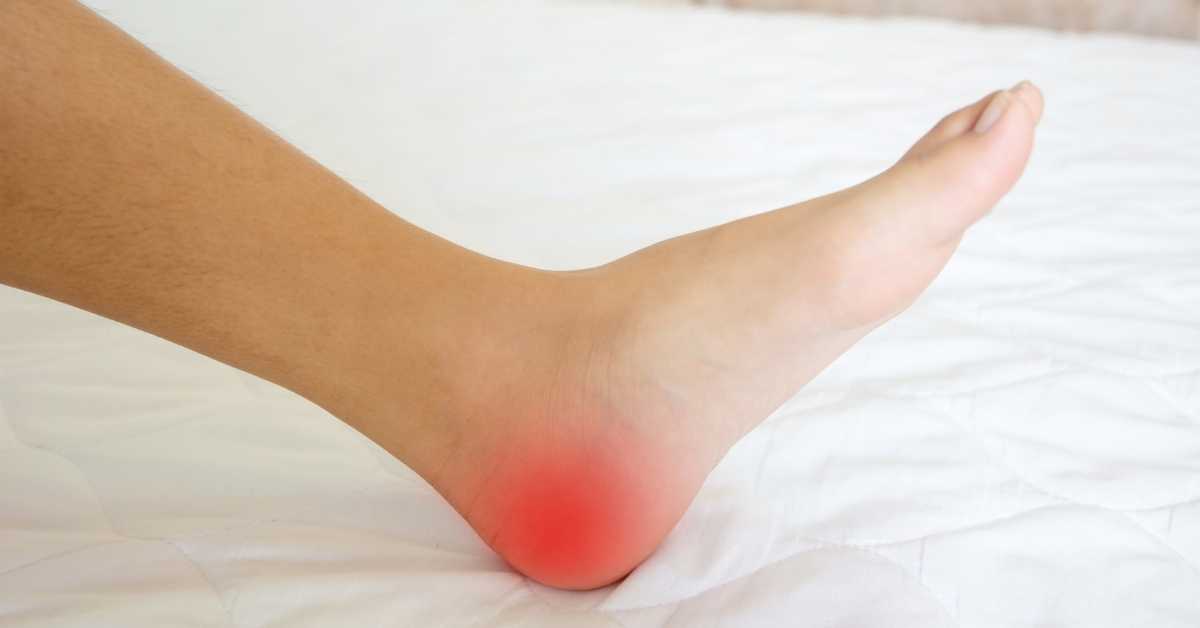 Talon douloureux après running : Pourquoi vous avez mal et comment rejouer sans douleur